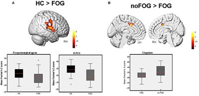 A Multimodal Imaging Approach Demonstrates Reduced Midbrain Functional Network Connectivity Is Associated With Freezing of Gait in Parkinson's Disease